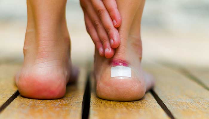 Comment prévenir les ampoules aux pieds ?