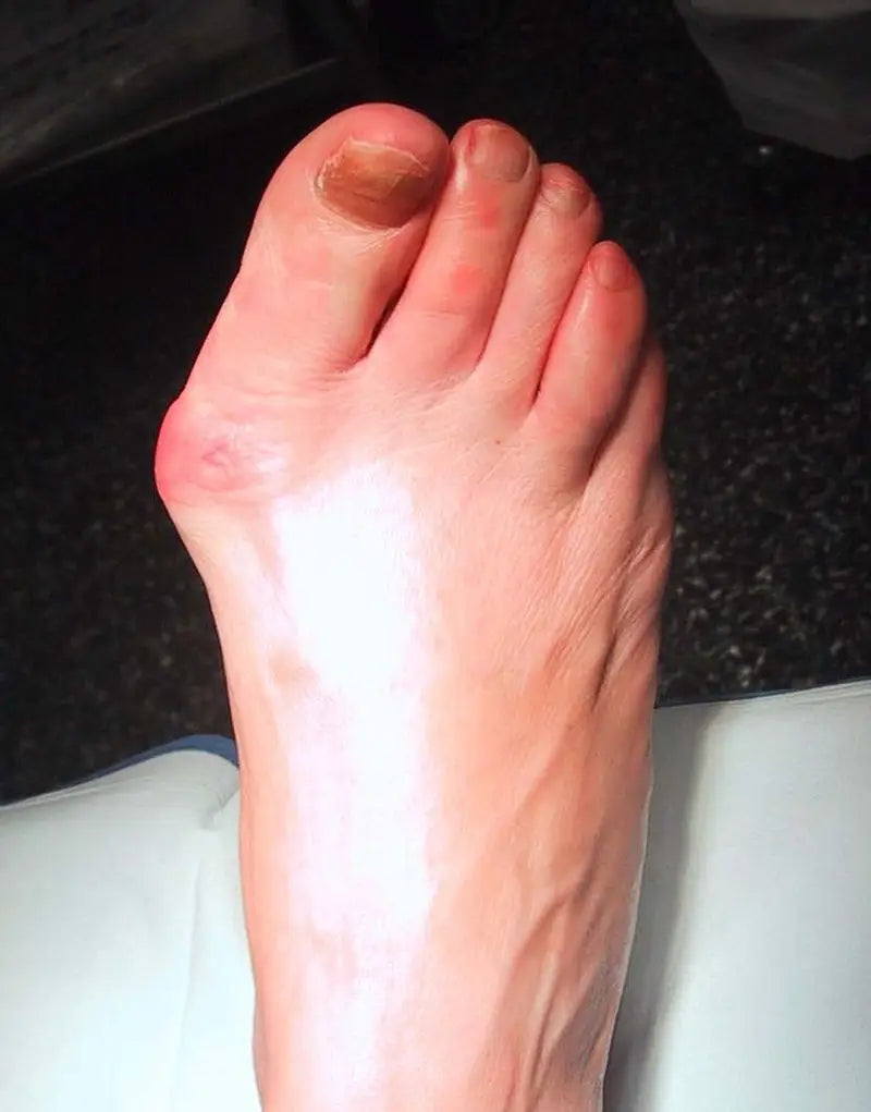 Comment traiter les oignons (hallux valgus) ?