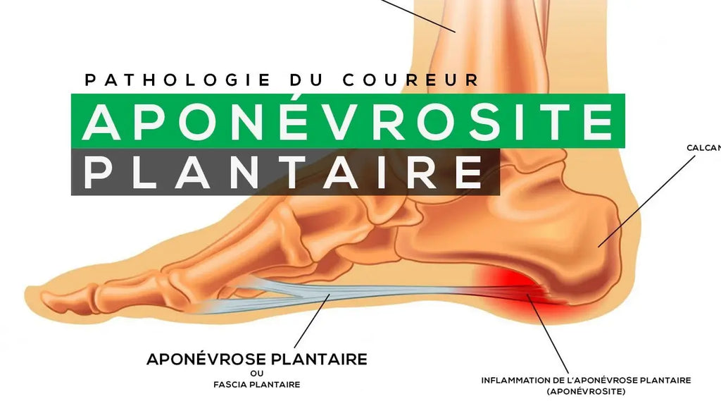 Qu’est-ce que l’Aponévrosite Plantaire ?