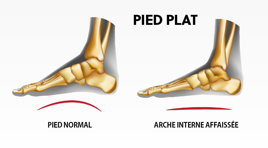 Qu’est-ce que le Pied Plat ?