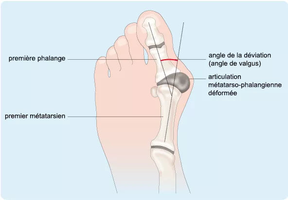 Qu’est-ce que l’hallux valgus ?